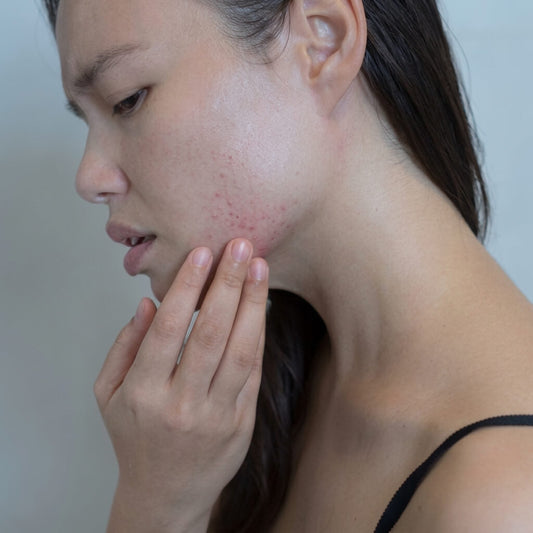 Woman with acne looking worried