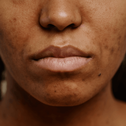Understanding Hyperpigmentation on Deeper Skin Tones